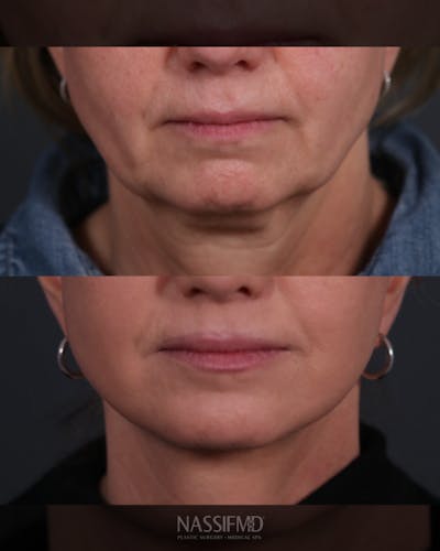 Facelift Before & After Gallery - Patient 730024 - Image 1