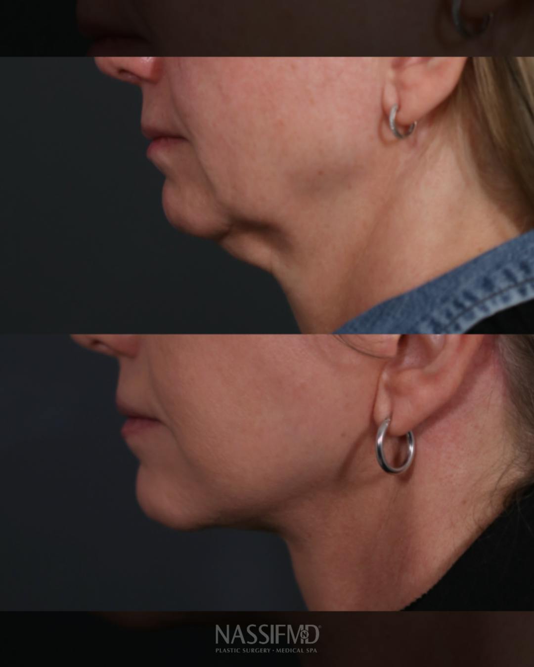 Facelift Before & After Gallery - Patient 730024 - Image 3