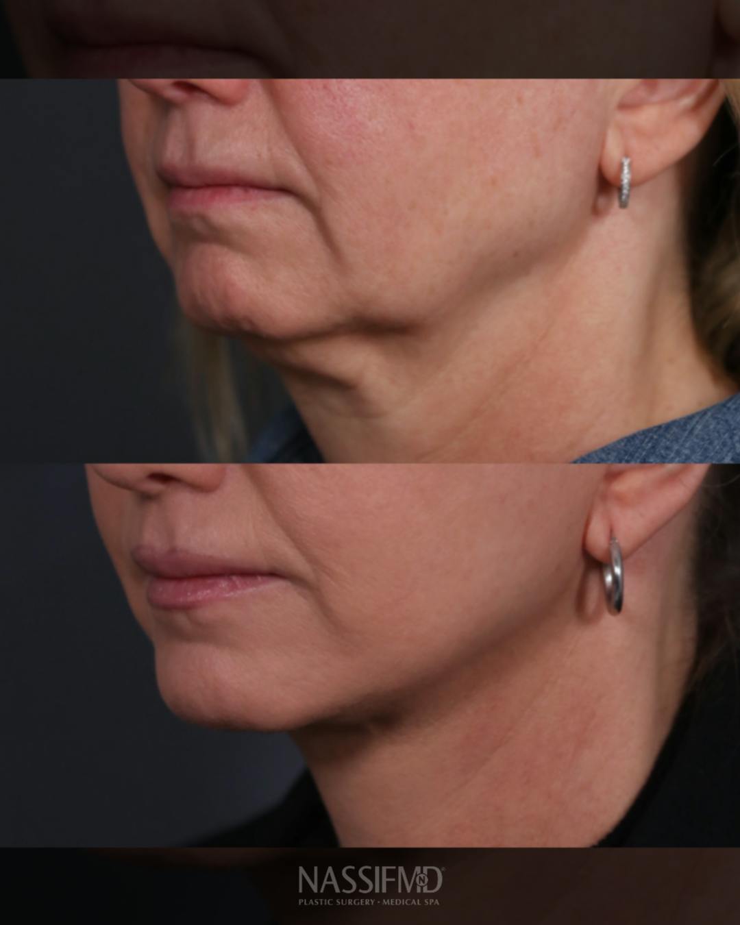 Facelift Before & After Gallery - Patient 730024 - Image 2