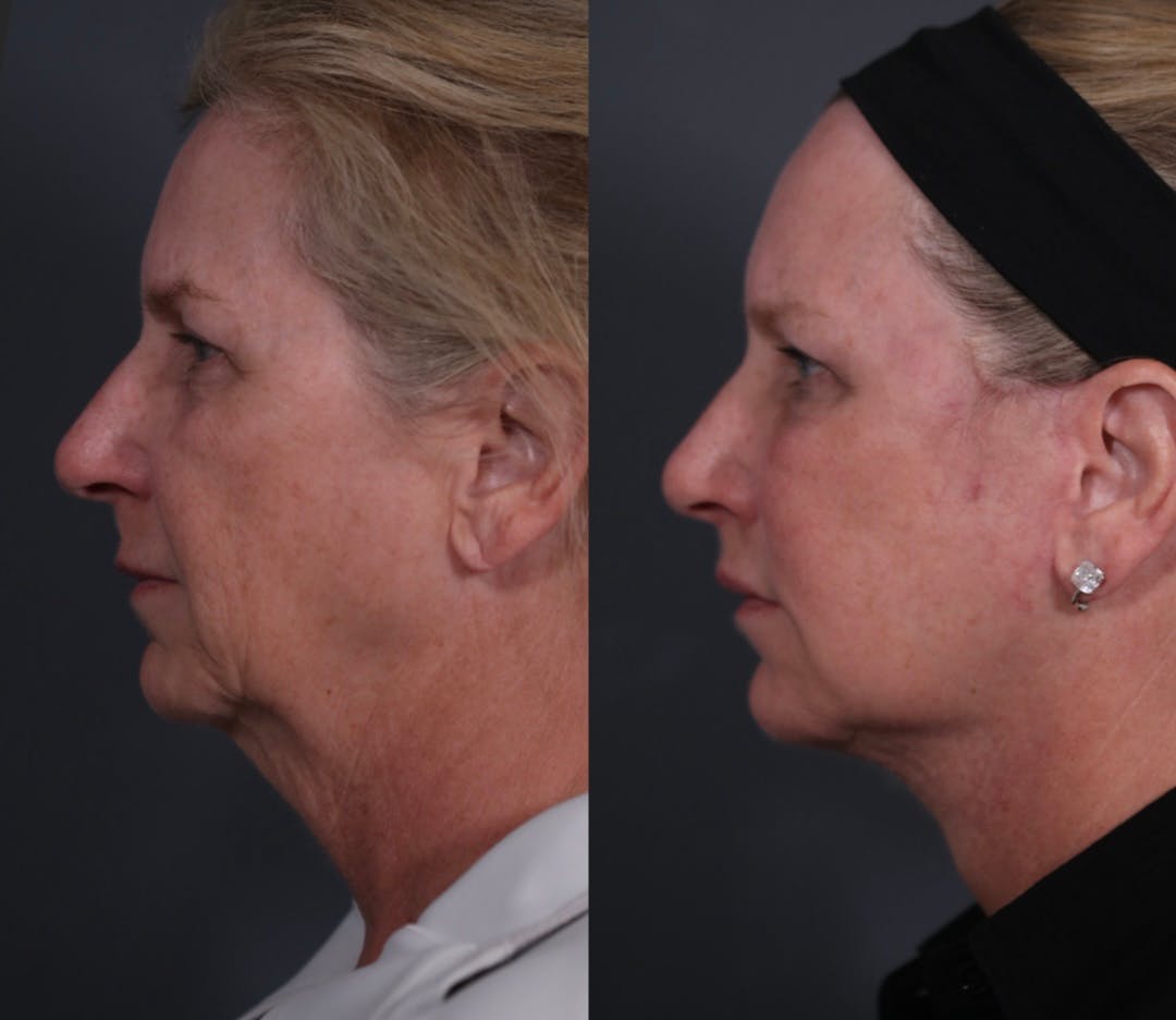 Facelift Before & After Gallery - Patient 205375 - Image 4