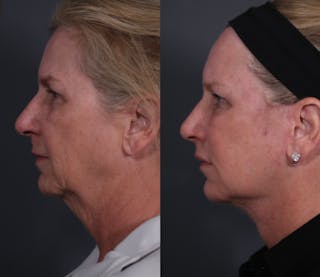 Brow Lift Before & After Gallery - Patient 218306 - Image 4