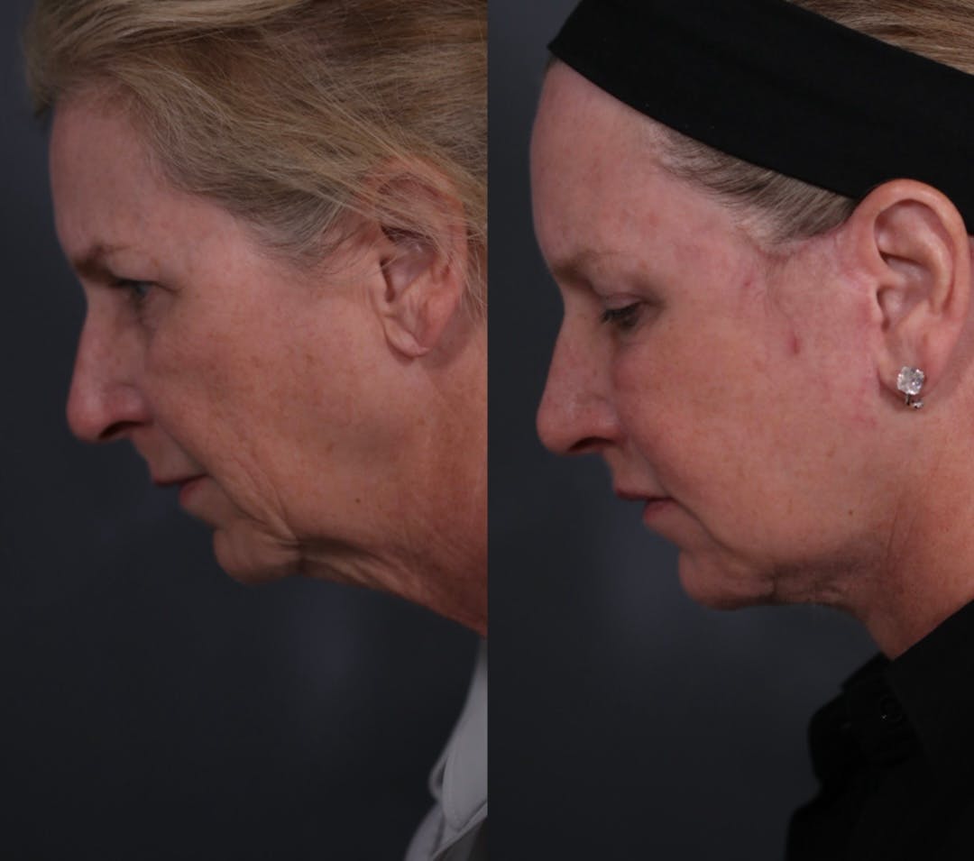 Facelift Before & After Gallery - Patient 205375 - Image 3