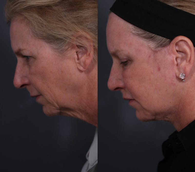 Brow Lift Before & After Gallery - Patient 218306 - Image 3