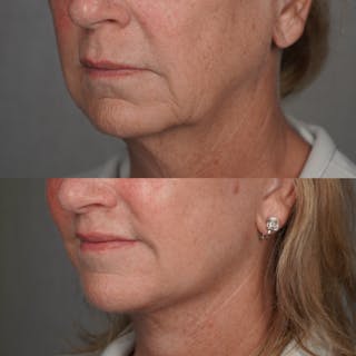 Brow Lift Before & After Gallery - Patient 218306 - Image 6