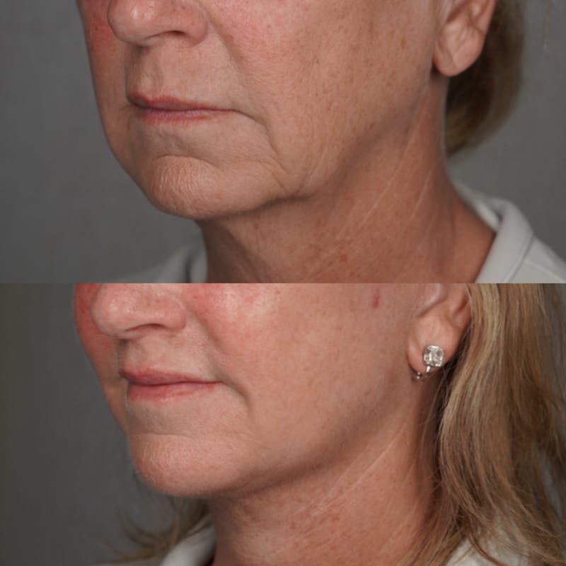 Brow Lift Before & After Gallery - Patient 218306 - Image 6