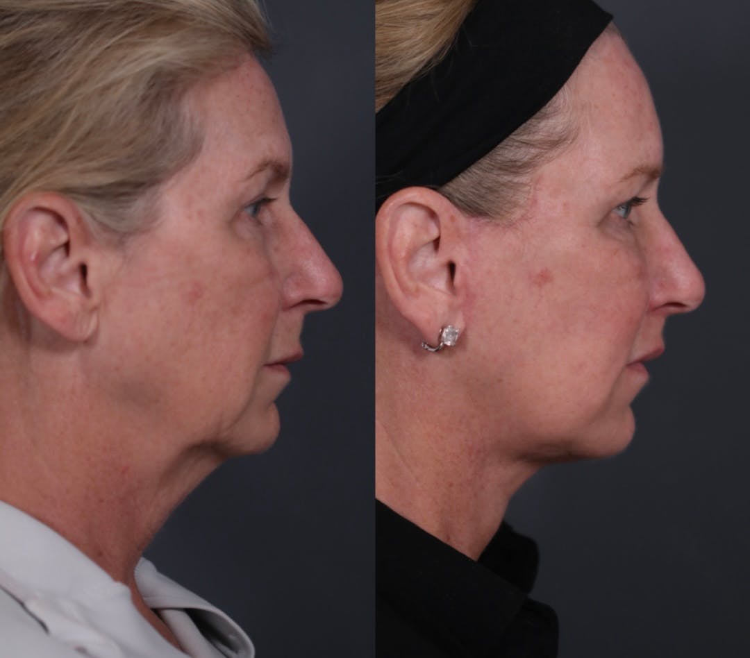 Facelift Before & After Gallery - Patient 205375 - Image 5