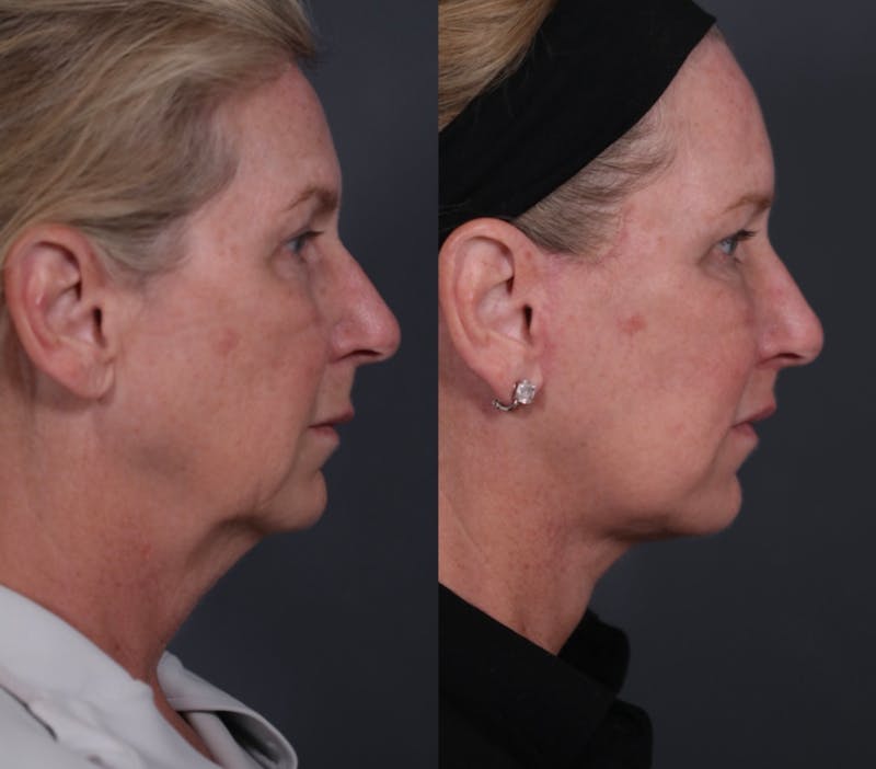 Brow Lift Before & After Gallery - Patient 218306 - Image 5