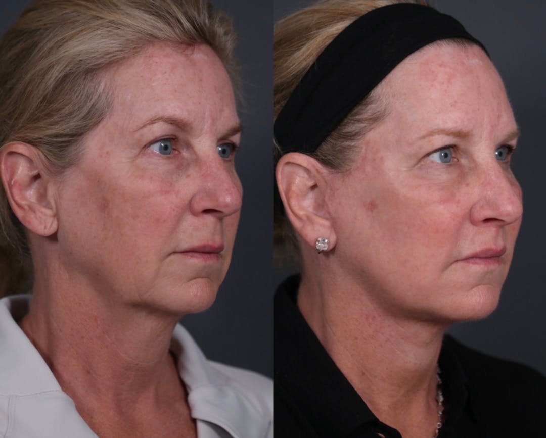 Facelift Before & After Gallery - Patient 205375 - Image 2