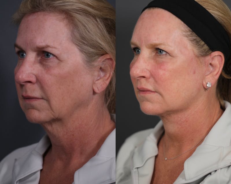 Brow Lift Before & After Gallery - Patient 218306 - Image 1