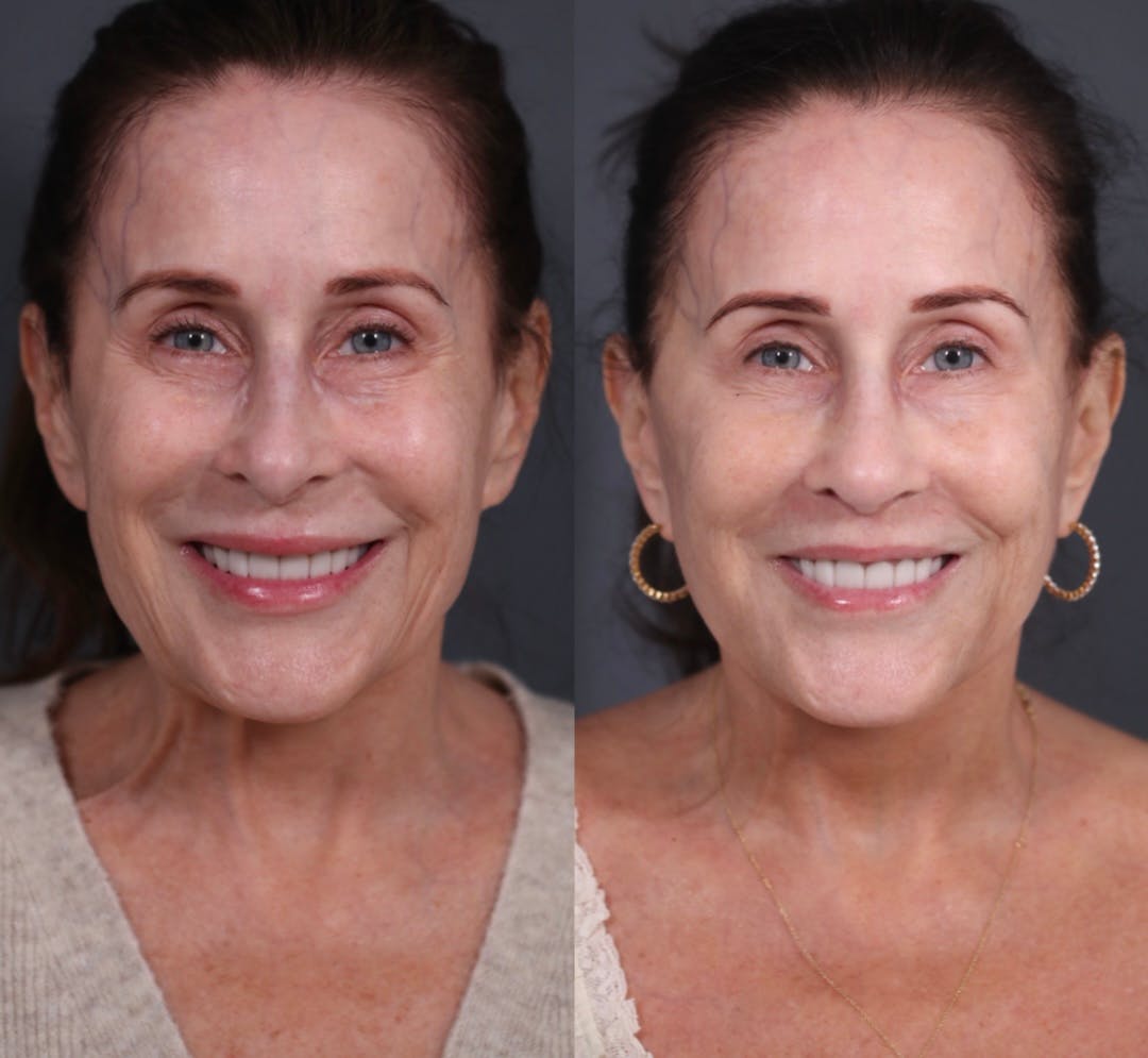 Facelift Before & After Gallery - Patient 149029 - Image 1