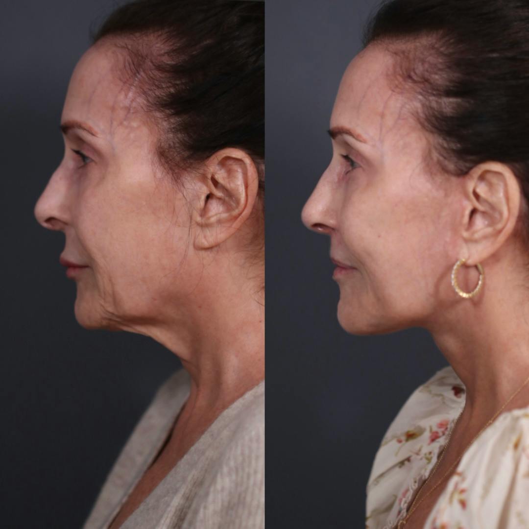 Facelift Before & After Gallery - Patient 149029 - Image 5