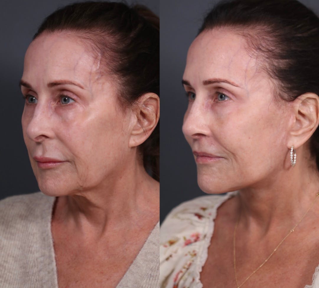 Facelift Before & After Gallery - Patient 149029 - Image 2