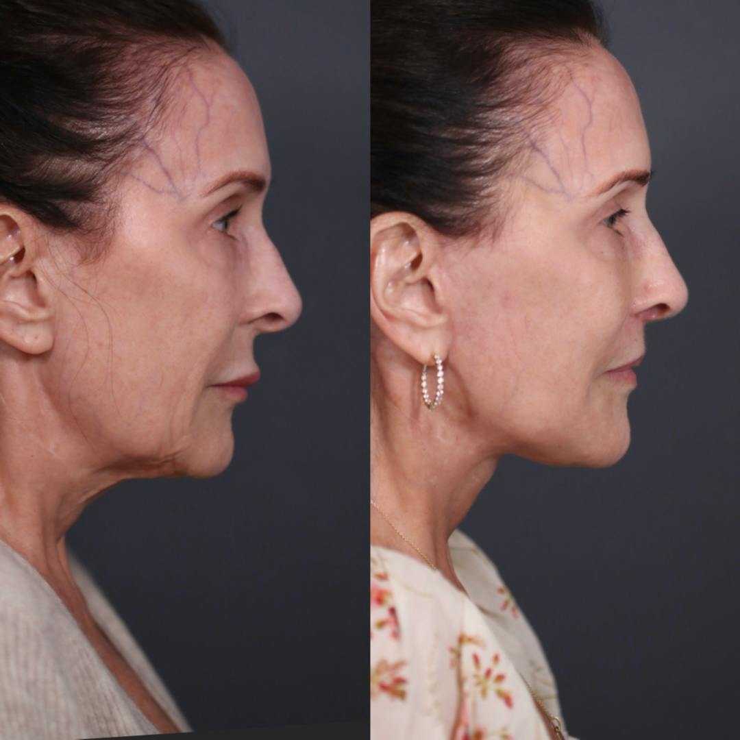 Facelift Before & After Gallery - Patient 149029 - Image 4