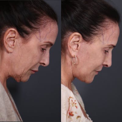 Neck Lift Before & After Gallery - Patient 358579 - Image 1