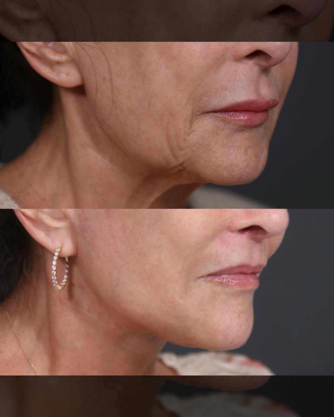 Lip Lift Before & After Gallery - Patient 158687 - Image 1