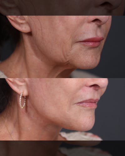 Lip Lift Before & After Gallery - Patient 158687 - Image 1
