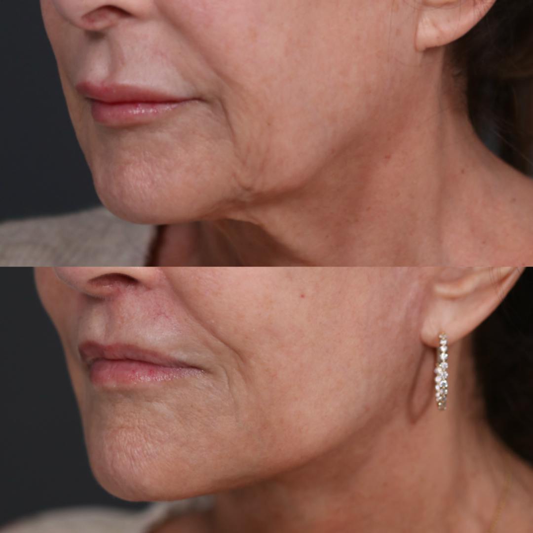 Lip Lift Before & After Gallery - Patient 158687 - Image 2