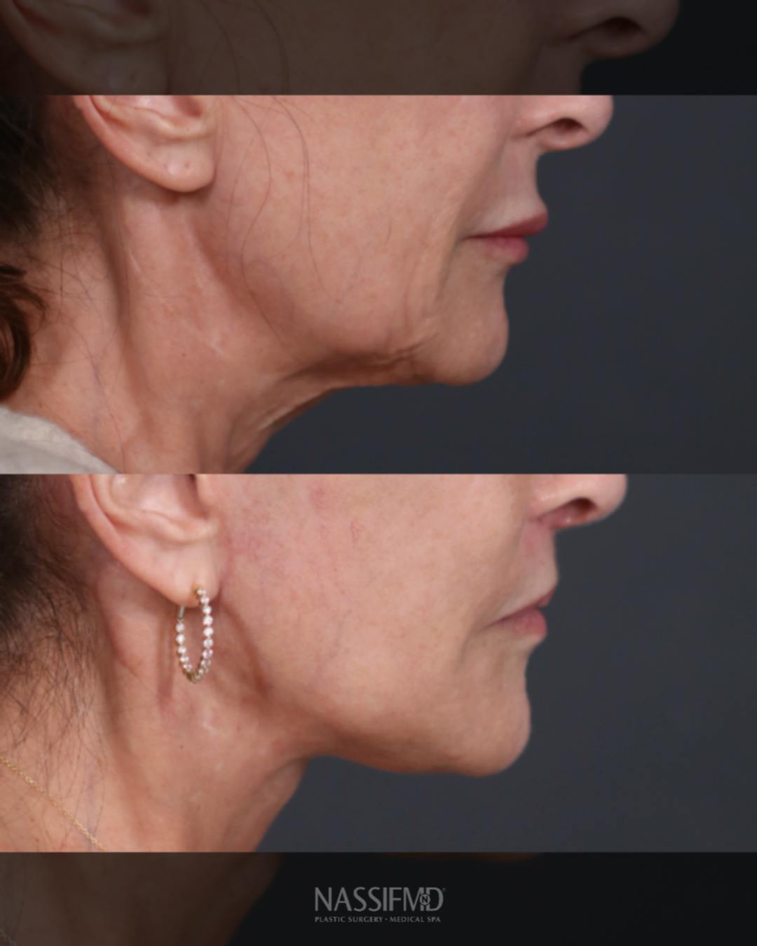 Lip Lift Before & After Gallery - Patient 158687 - Image 3
