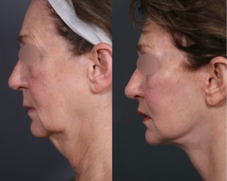 Facelift Before & After Gallery - Patient 298414 - Image 2