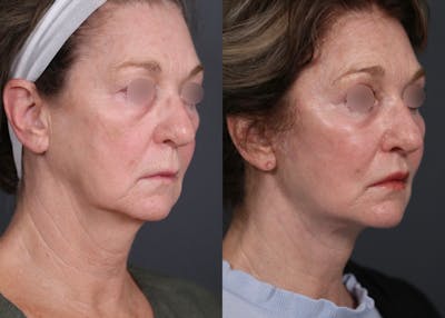 Facelift Before & After Gallery - Patient 298414 - Image 1