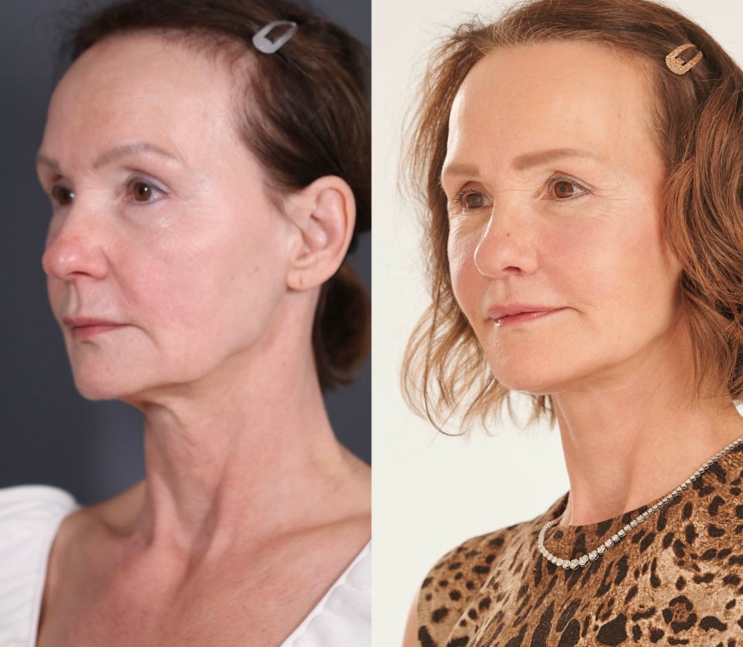 Facelift Before & After Gallery - Patient 374446 - Image 2