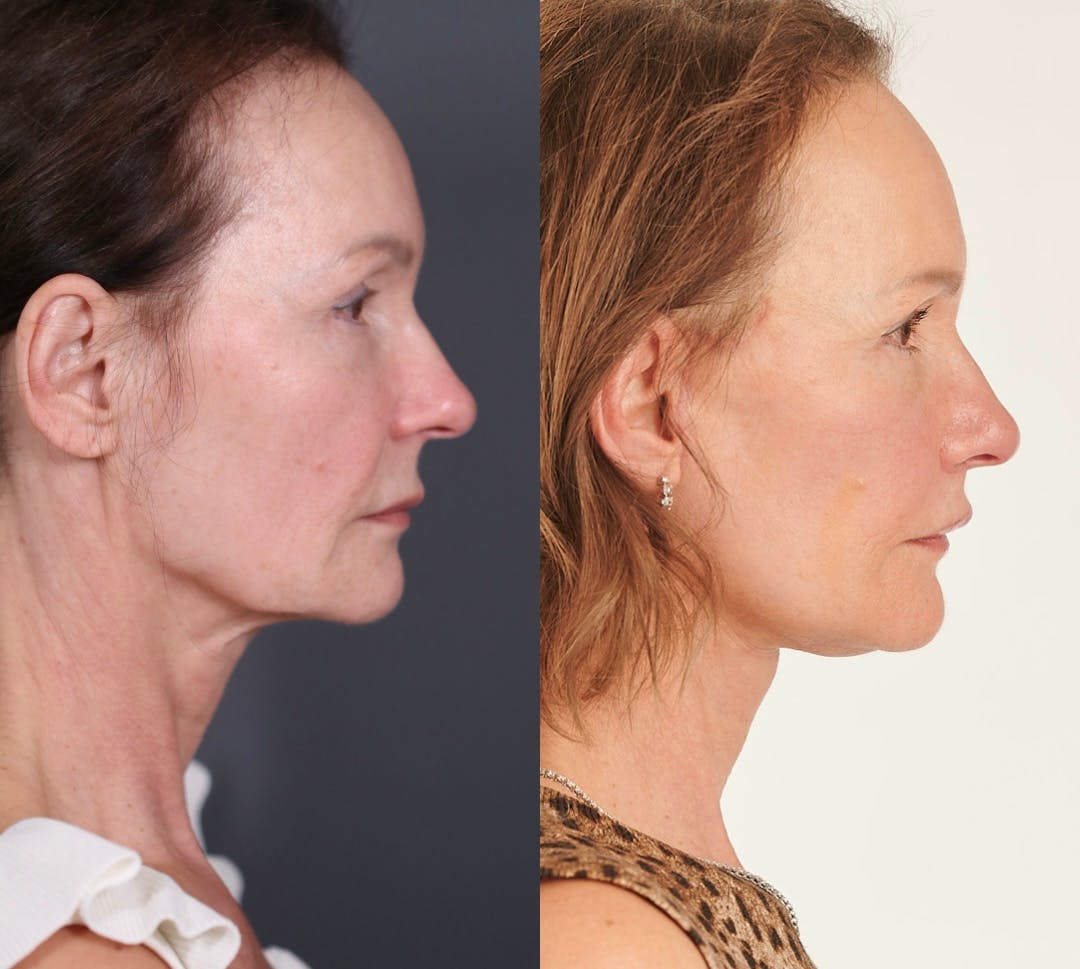Facelift Before & After Gallery - Patient 374446 - Image 1