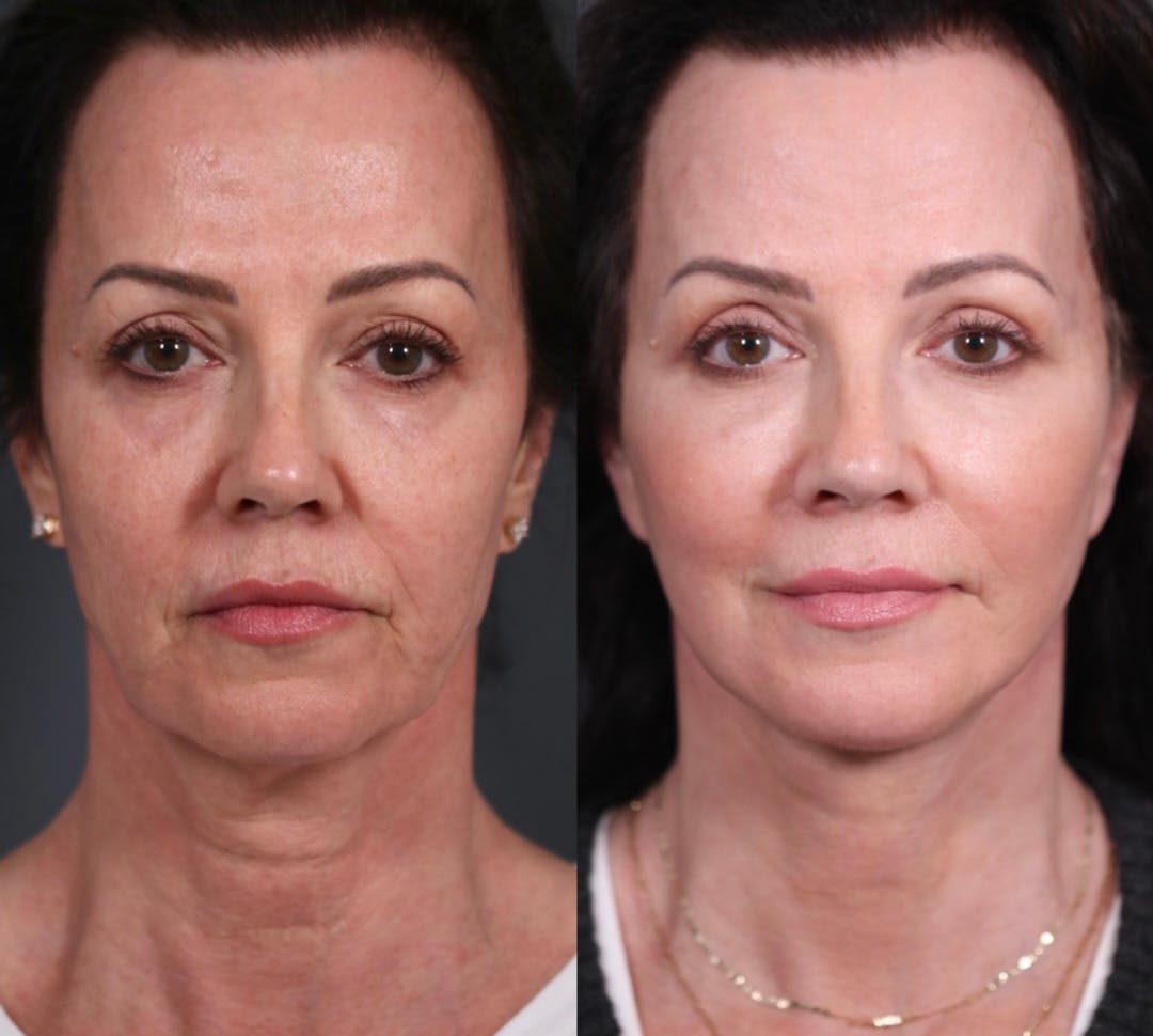 Upper Blepharoplasty Before & After Gallery - Patient 236260 - Image 1