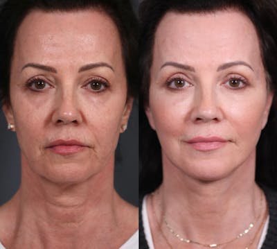 Facelift Before & After Gallery - Patient 359797 - Image 1