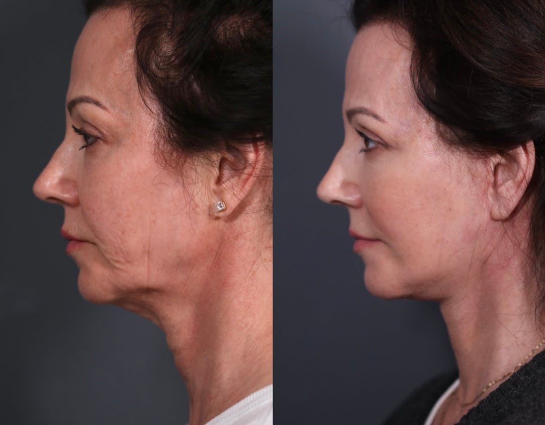 Upper Blepharoplasty Before & After Gallery - Patient 236260 - Image 6