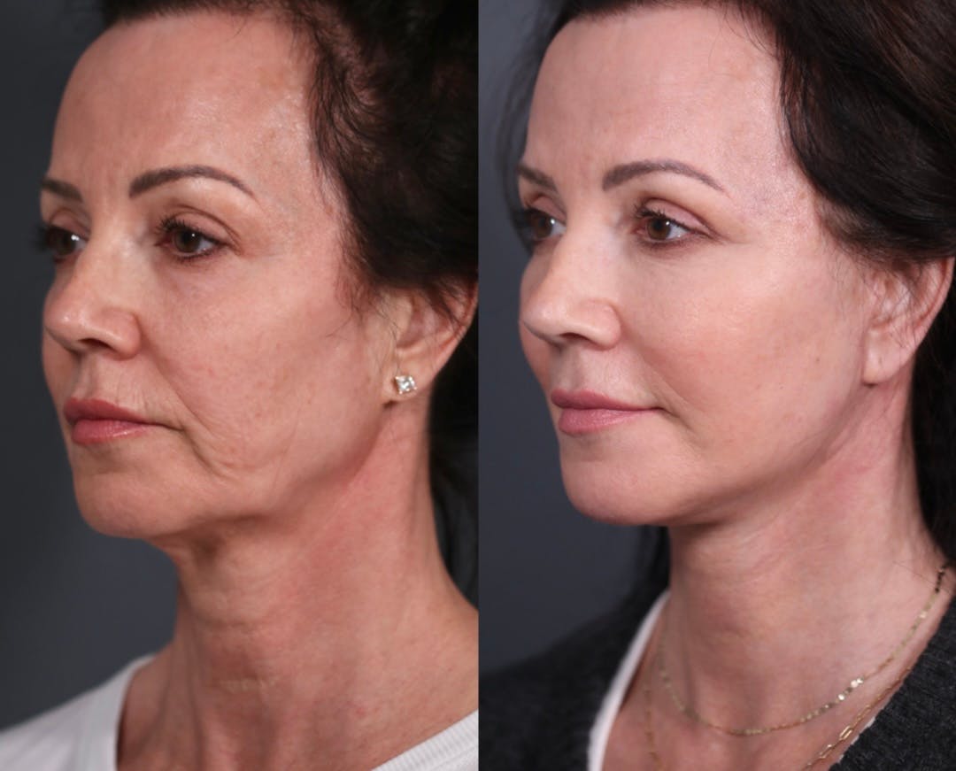 Upper Blepharoplasty Before & After Gallery - Patient 236260 - Image 5