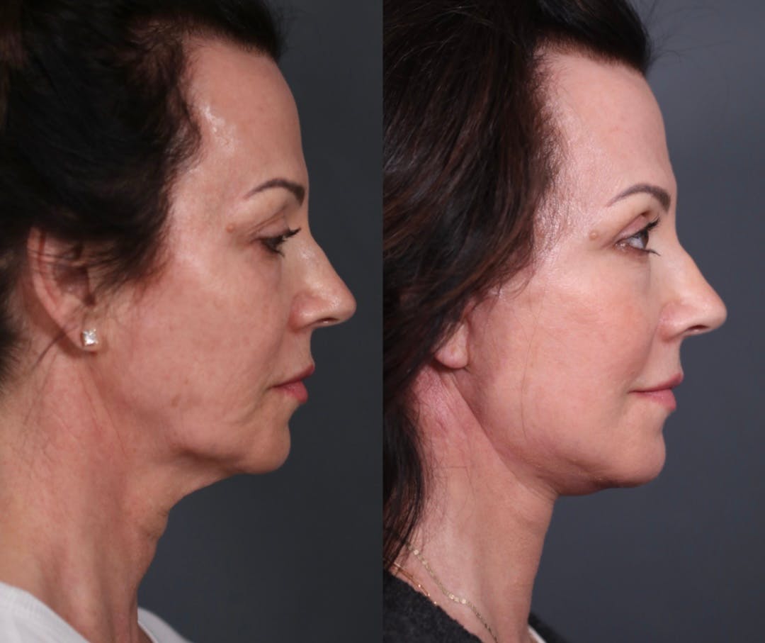 Upper Blepharoplasty Before & After Gallery - Patient 236260 - Image 4
