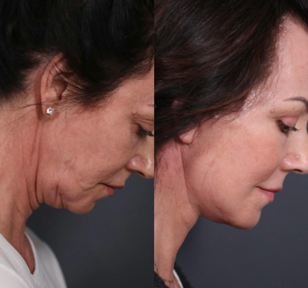 Upper Blepharoplasty Before & After Gallery - Patient 236260 - Image 3