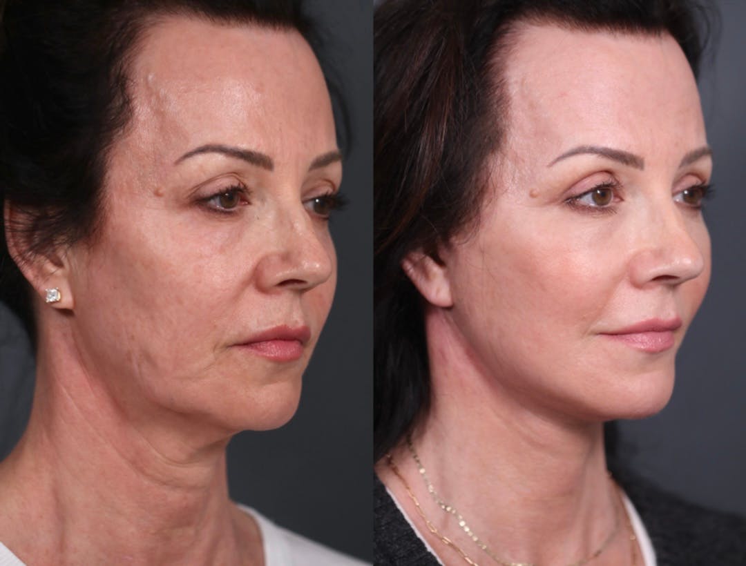Upper Blepharoplasty Before & After Gallery - Patient 236260 - Image 2