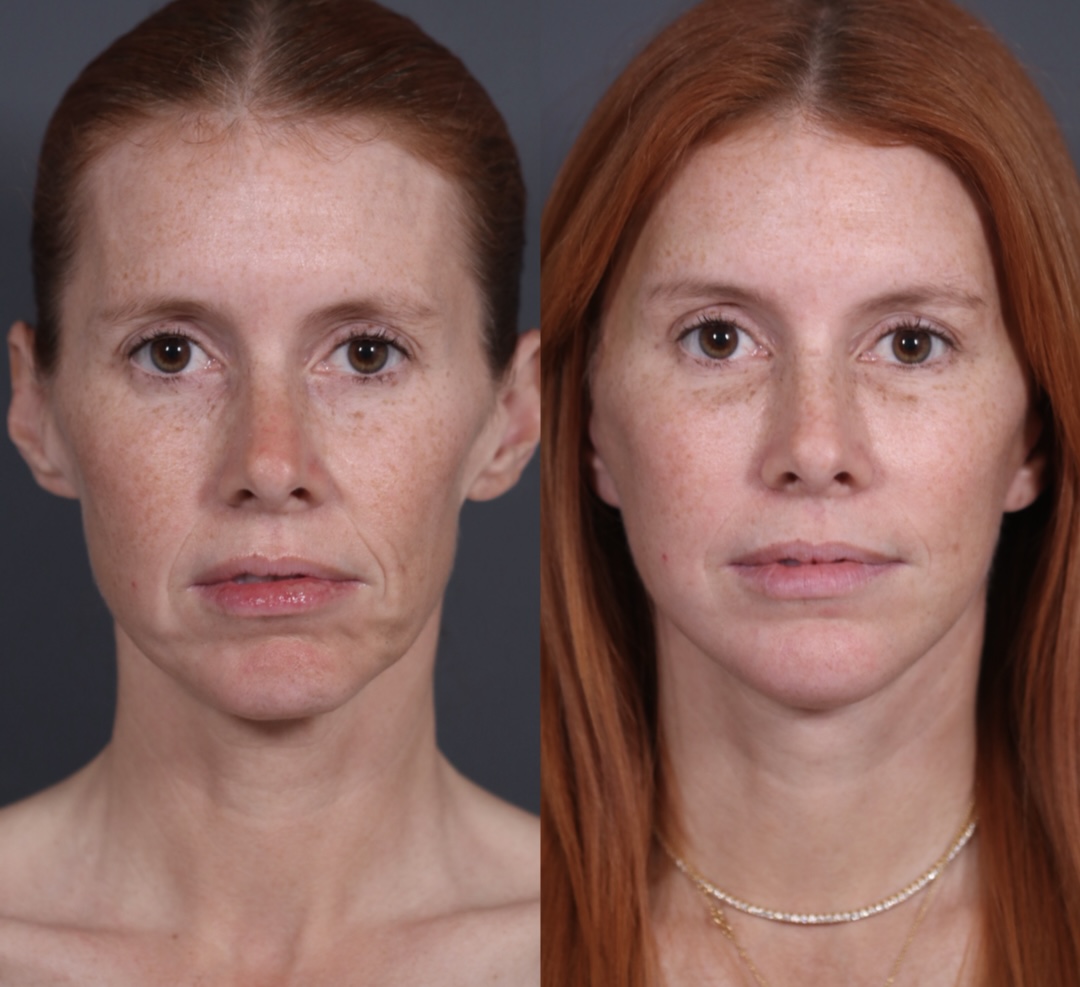 Patient 135838 | Facelift Before & After Photos | NassifMD Plastic