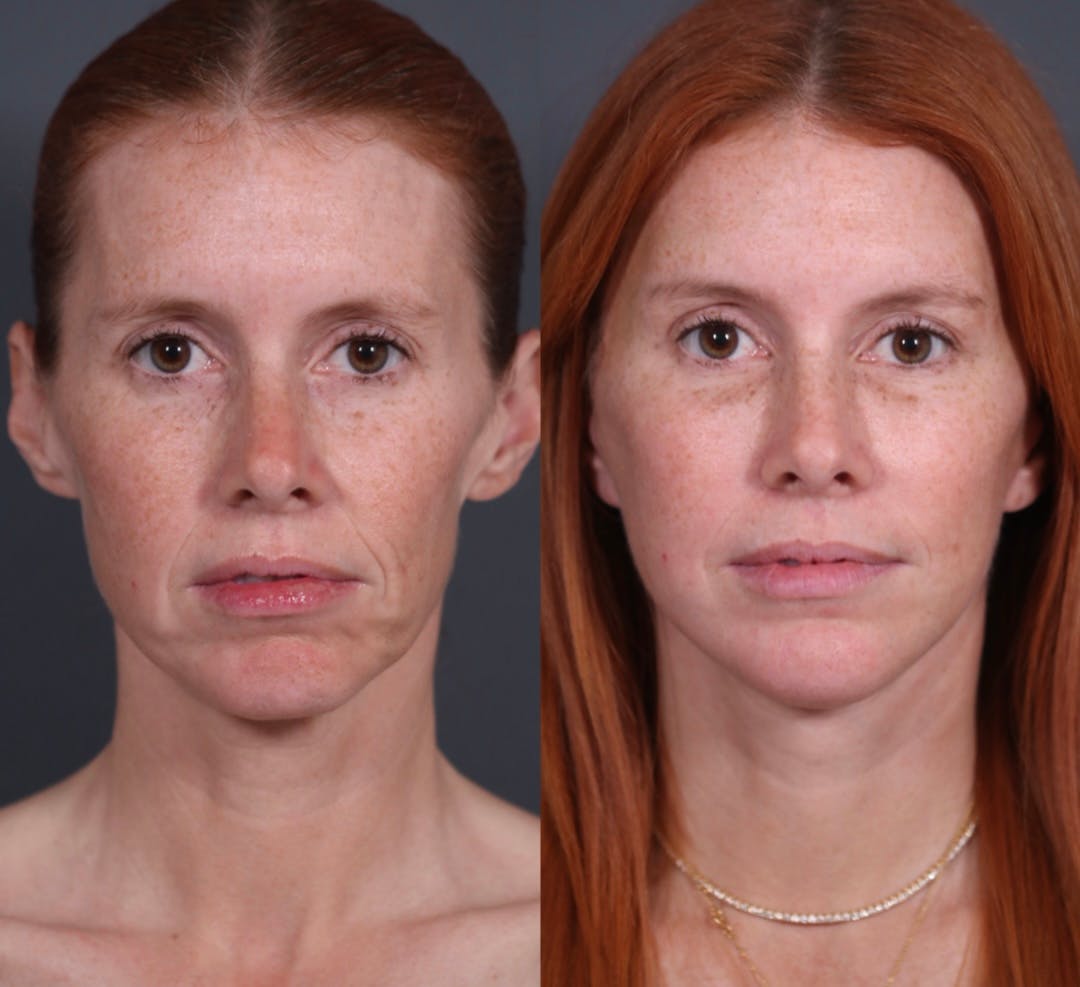 Brow Lift Before & After Gallery - Patient 969933 - Image 5