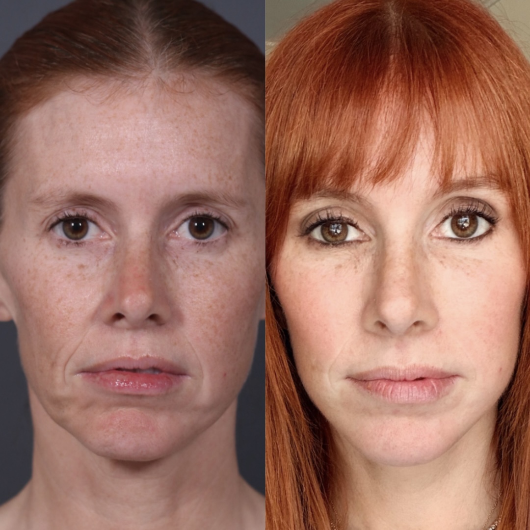 Patient 135838 | Facelift Before & After Photos | NassifMD Plastic