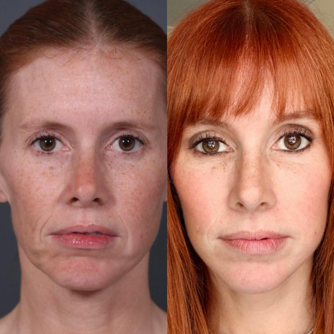 Brow Lift Before & After Gallery - Patient 969933 - Image 4