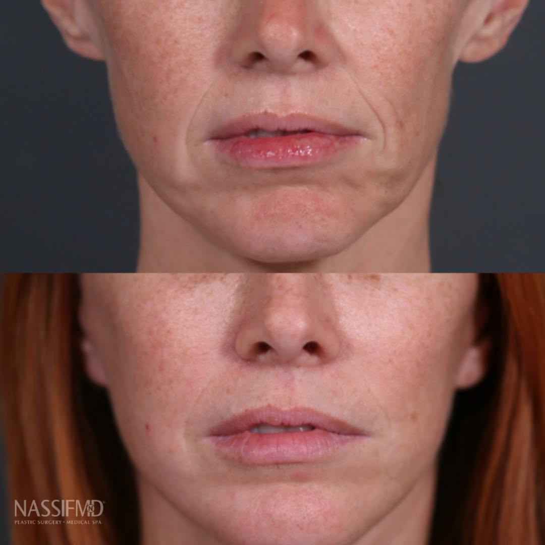 Brow Lift Before & After Gallery - Patient 969933 - Image 7