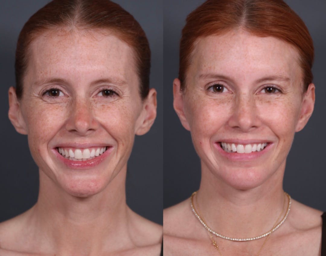 Brow Lift Before & After Gallery - Patient 969933 - Image 1