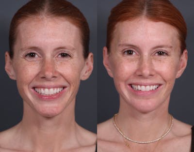 Facelift Before & After Gallery - Patient 135838 - Image 1