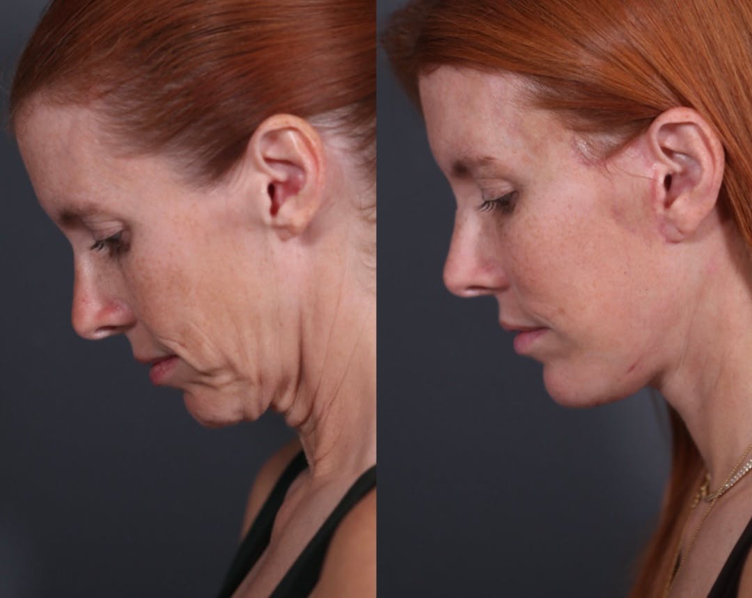 Brow Lift Before & After Gallery - Patient 969933 - Image 3