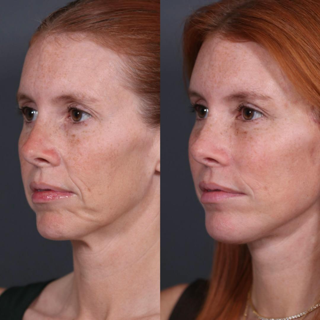 Brow Lift Before & After Gallery - Patient 969933 - Image 6