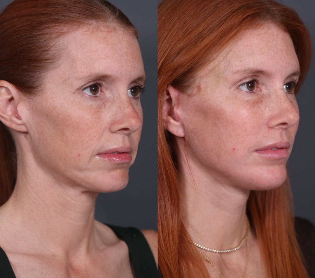Brow Lift Before & After Gallery - Patient 969933 - Image 2