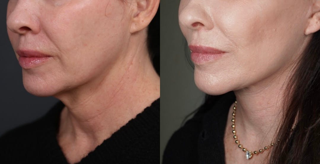 Neck Lift Before & After Gallery - Patient 947470 - Image 3