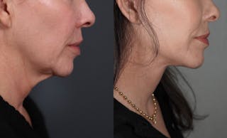 Facelift Before & After Gallery - Patient 298886 - Image 2