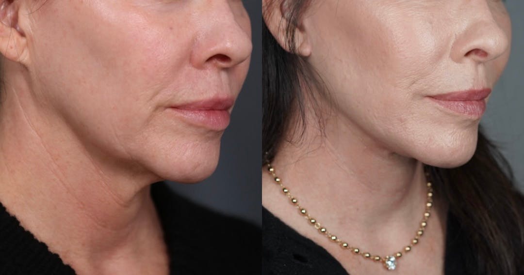 Neck Lift Before & After Gallery - Patient 947470 - Image 1