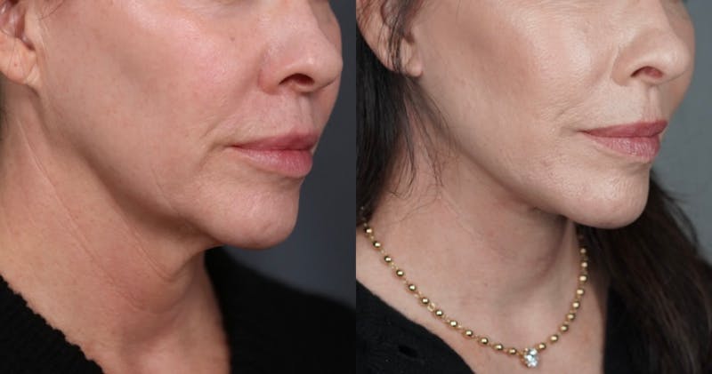 Facelift Before & After Gallery - Patient 298886 - Image 1