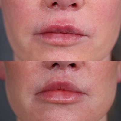 Lip Lift Before & After Gallery - Patient 416051 - Image 1