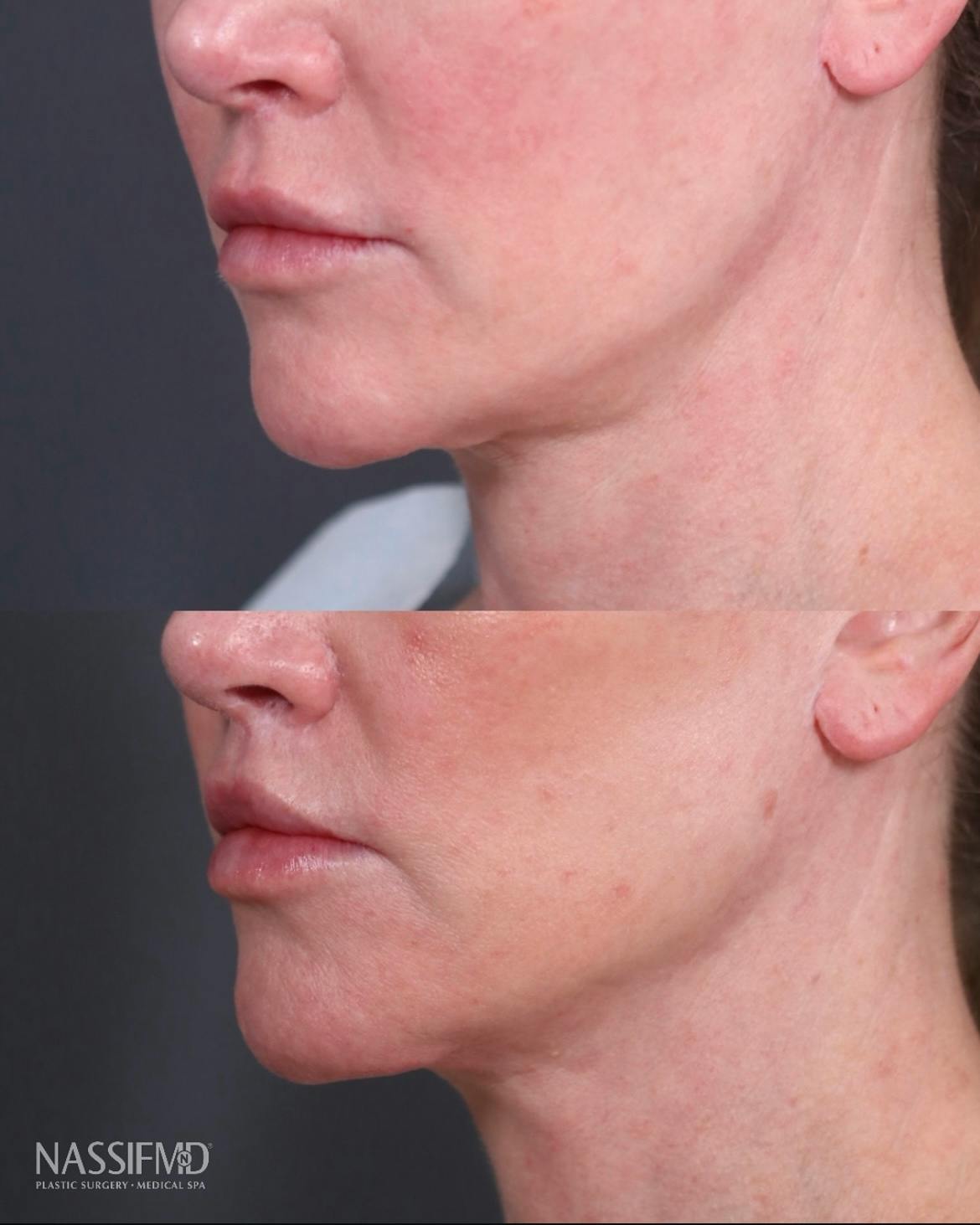 Lip Lift Before & After Gallery - Patient 416051 - Image 2