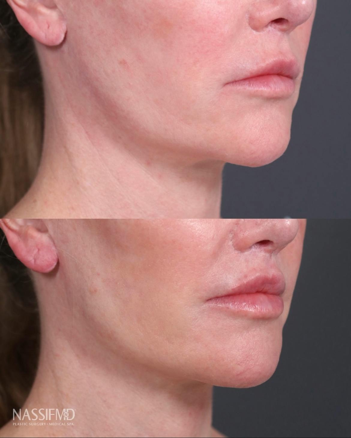 Lip Lift Before & After Gallery - Patient 416051 - Image 3